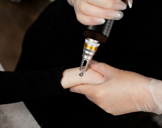 Unlocking the Secrets of Laser Tattoo Removal: What You Need to Know