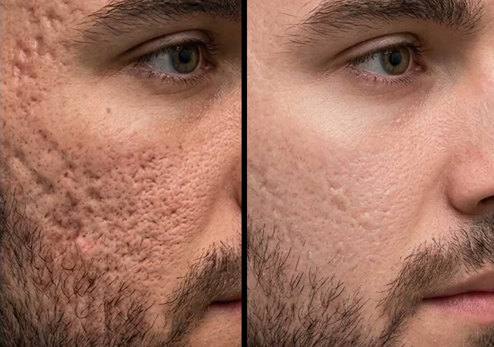 Acne-Acne-Scarring-gallery-1