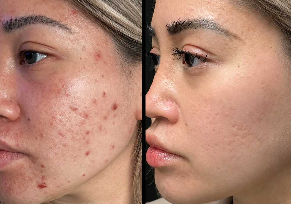 Acne-Acne-Scarring-gallery-3