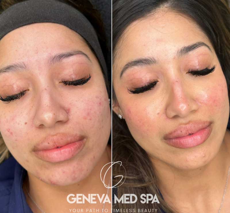Chemical-Peel-Frisco-5