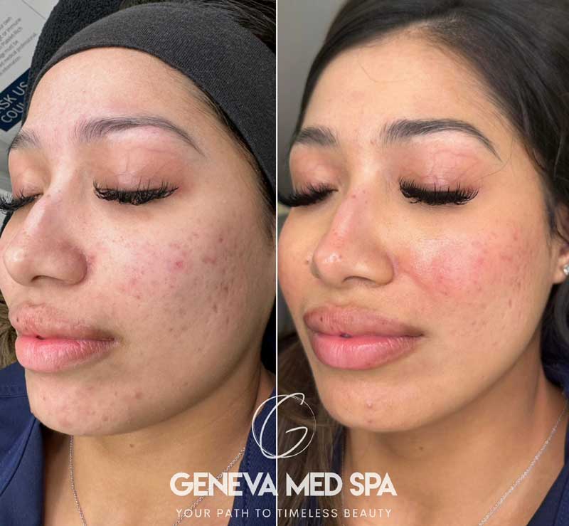 Chemical-Peel-Frisco-6