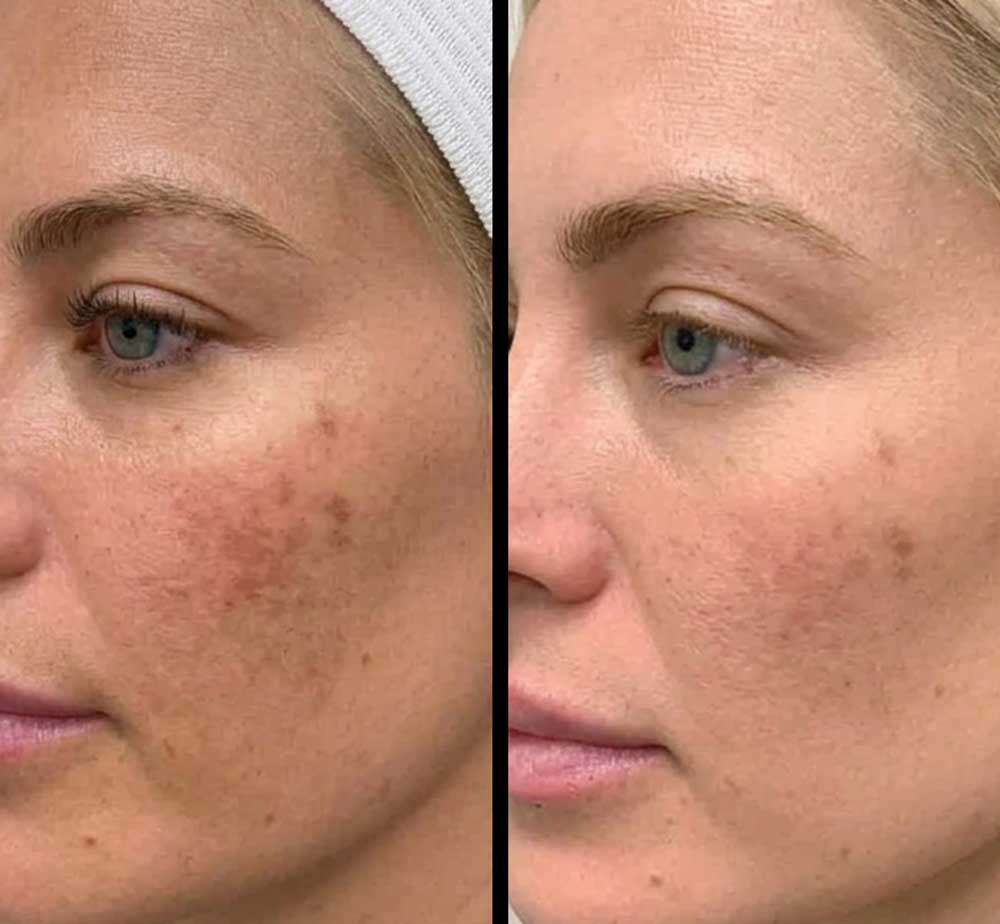 Chemical-Peel-Frisco-book