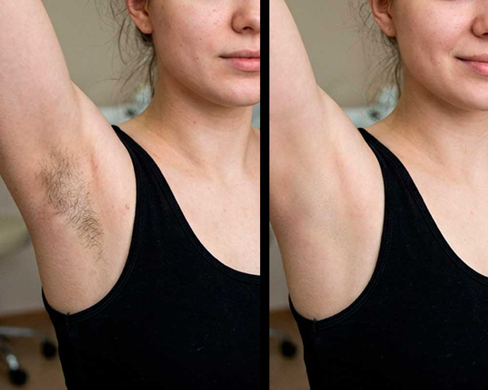 Laser-Hair-Removal-gallery