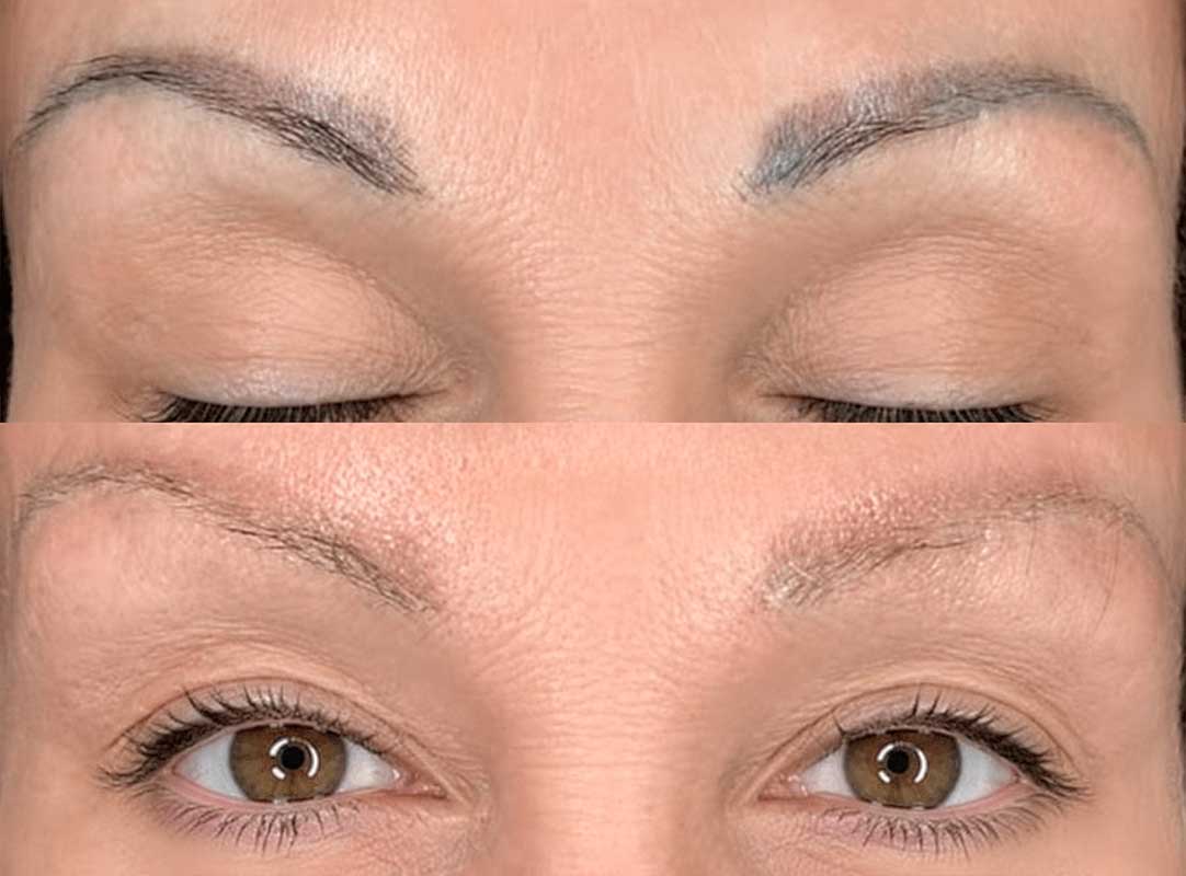 Laser-Tattoo-Removal-Frisco-Texas-gallery-3