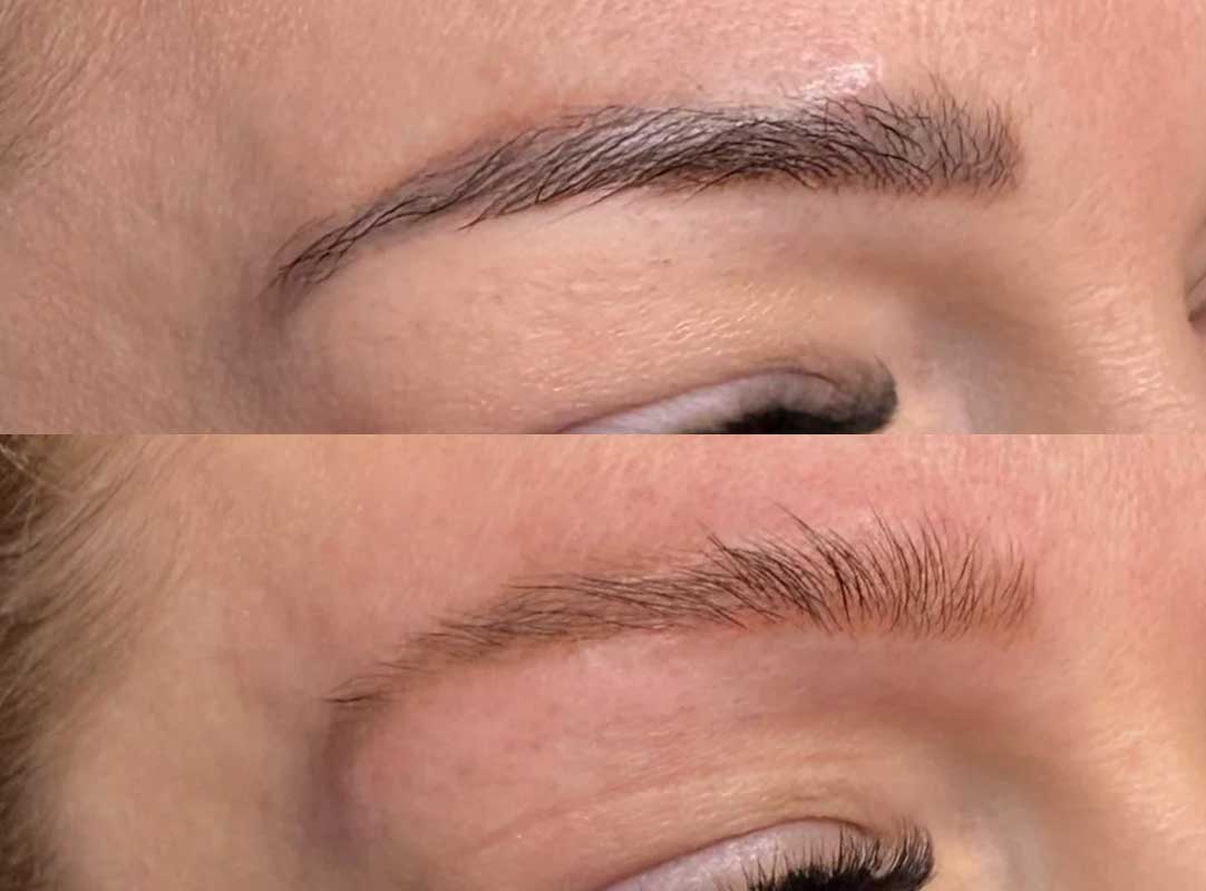 Laser-Tattoo-Removal-Frisco-Texas-gallery
