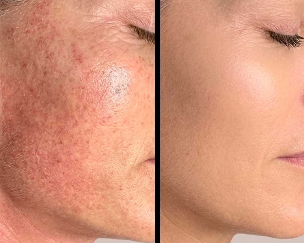 Light-&-Bright-Laser-Treatment-Frisco-gallery-2