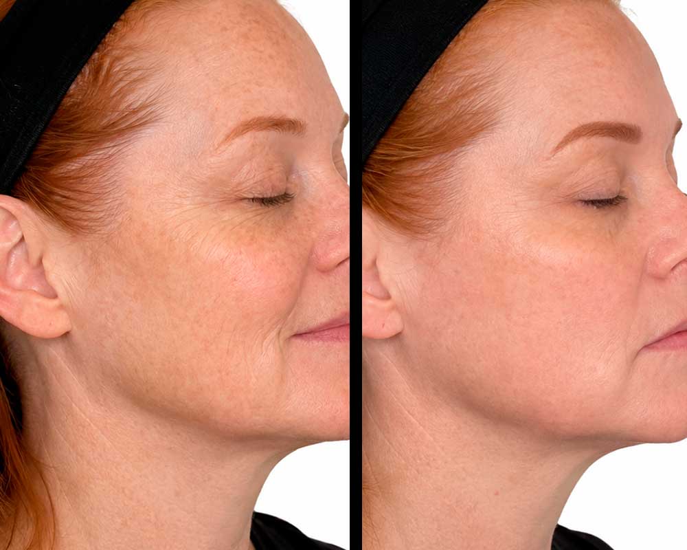Light-&-Bright-Laser-Treatment-Frisco-gallery-3