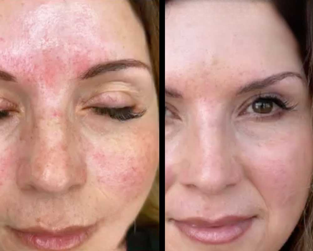 Light-&-Bright-Laser-Treatment-Frisco-gallery
