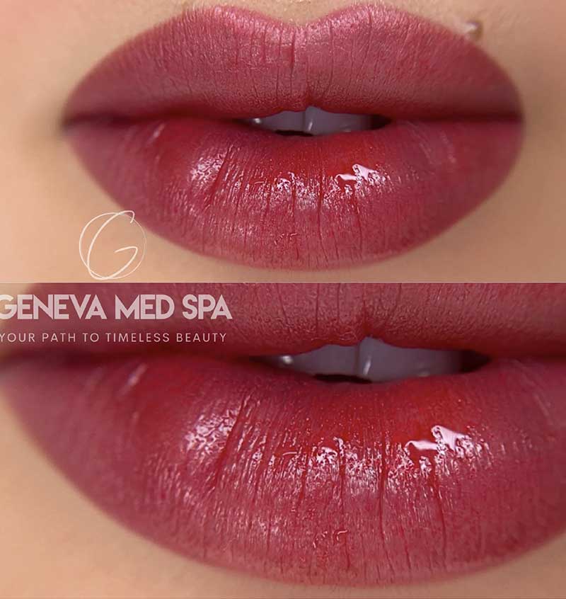 Lip Pigmentation/Lip Color Correction Frisco, TX | Geneva Med Spa