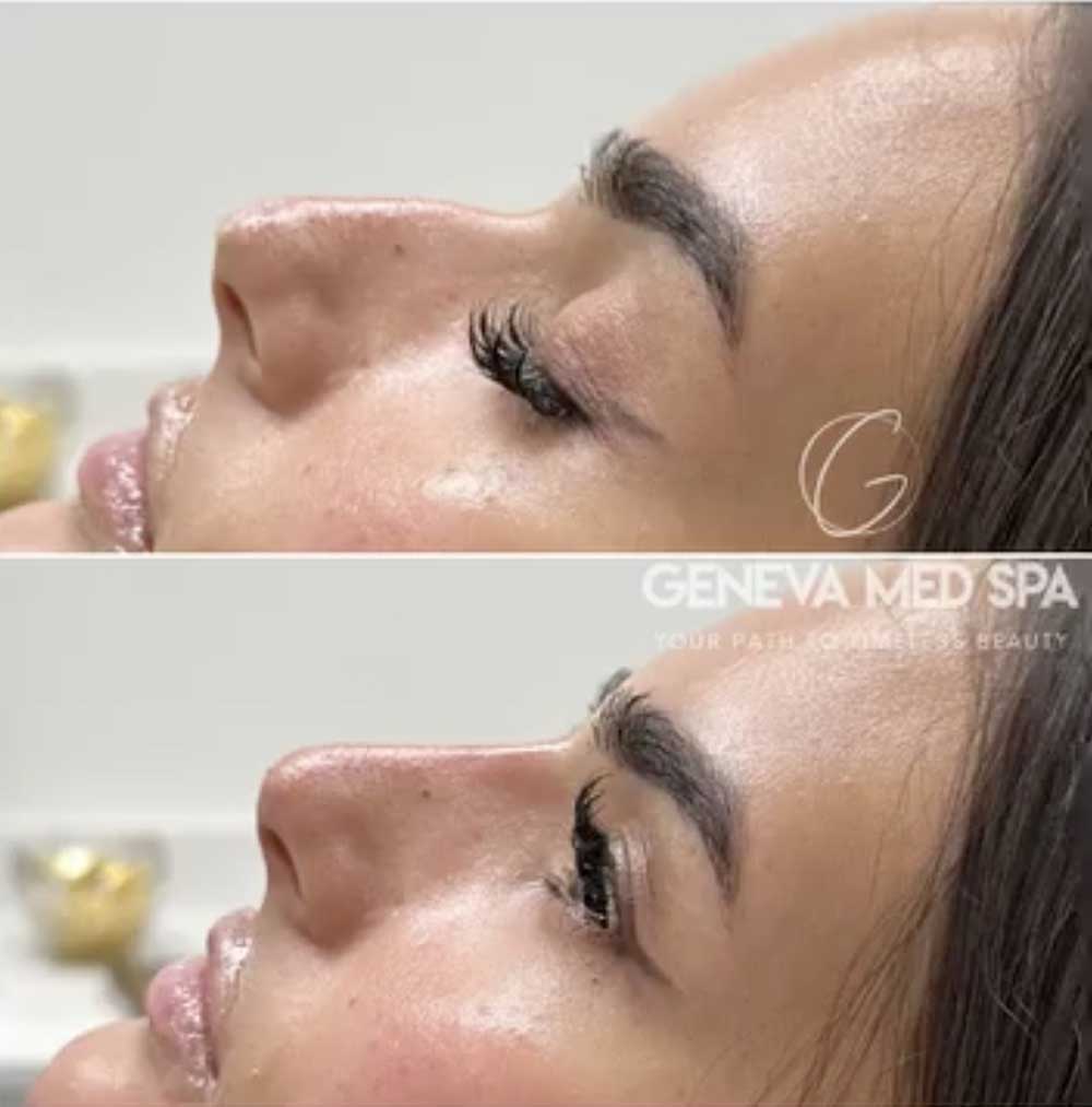 Liquid-Rhinoplasty-Frisco