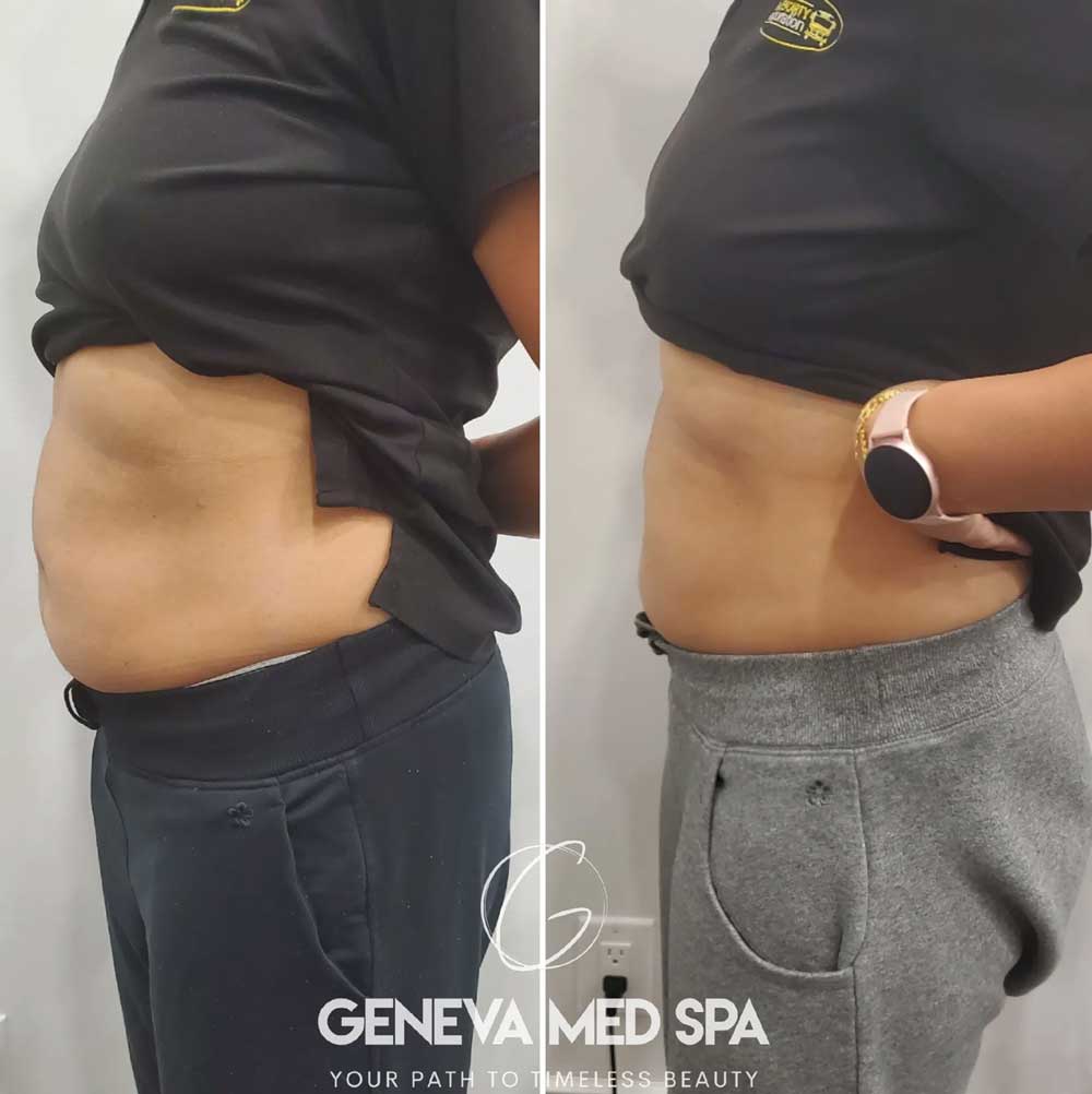 Non-Surgical-Fat-Reduction-in-Frisco-gallery-2