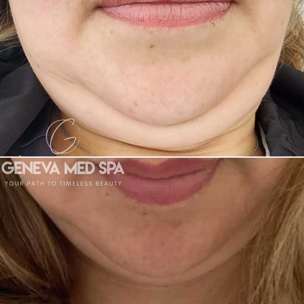 Non-Surgical-Fat-Reduction-in-Frisco-gallery