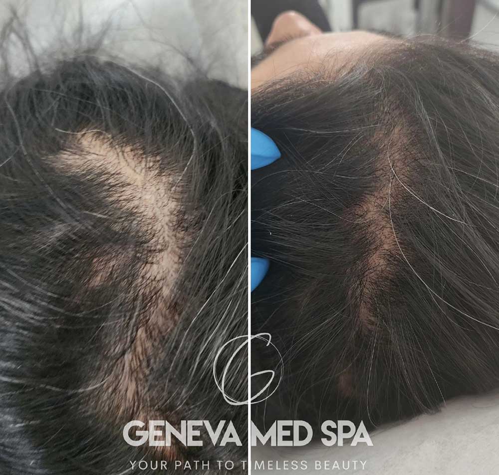 PRP-treatments-Frisco-Texas-gallery-2