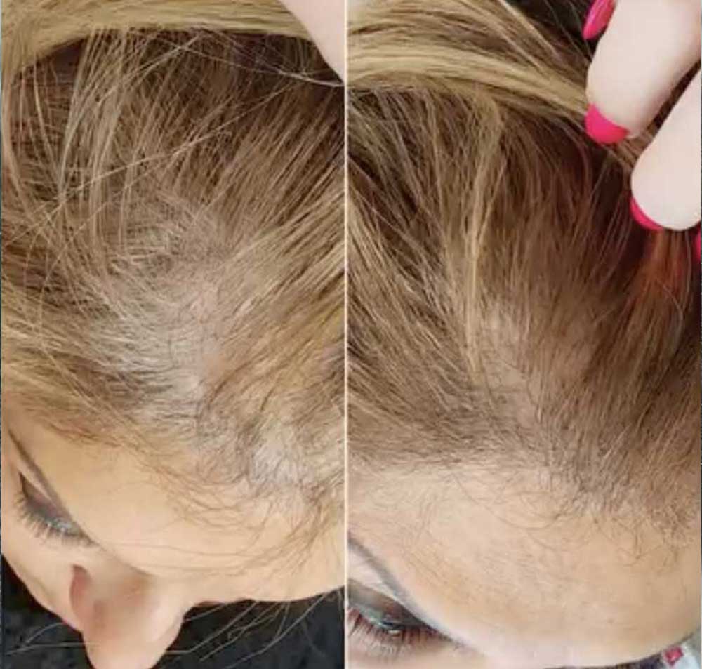 PRP-treatments-Frisco-Texas-gallery-3