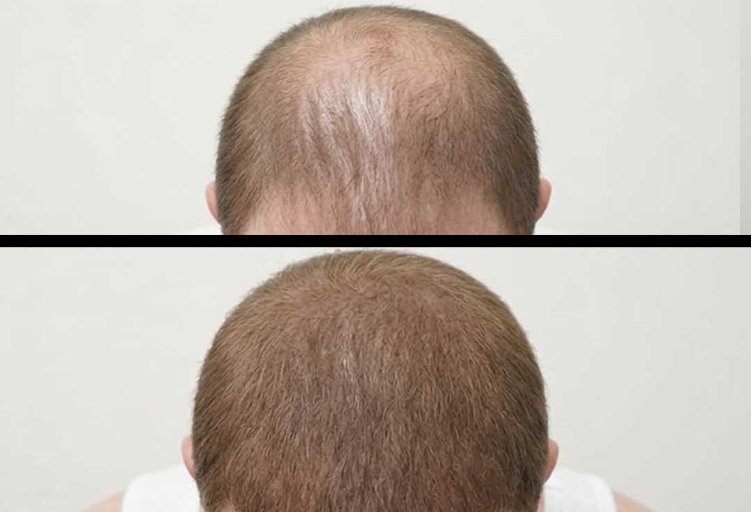 Scalp-Pigmentation-frisco-gallery-1