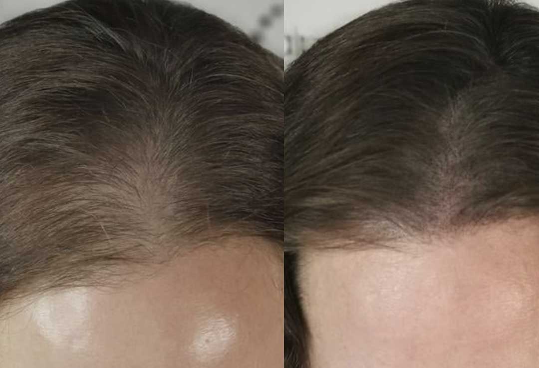 Scalp-Pigmentation-frisco-gallery-2