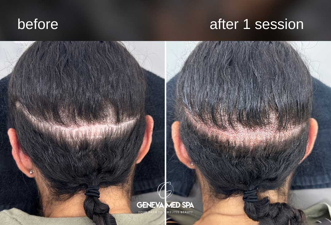 Scalp-Pigmentation-frisco-gallery