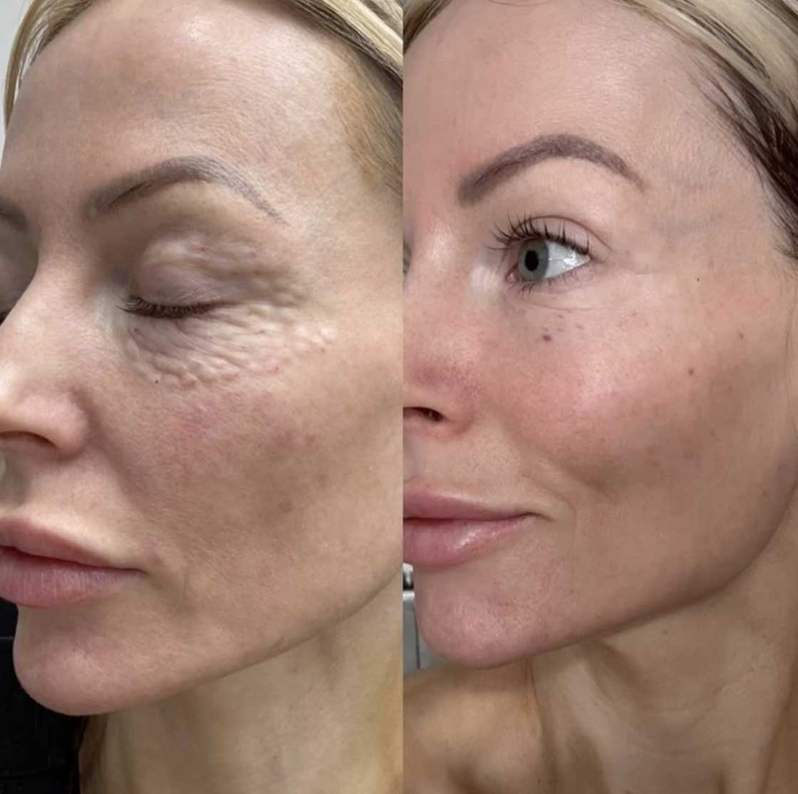 Skin-Booster-Frisco-4