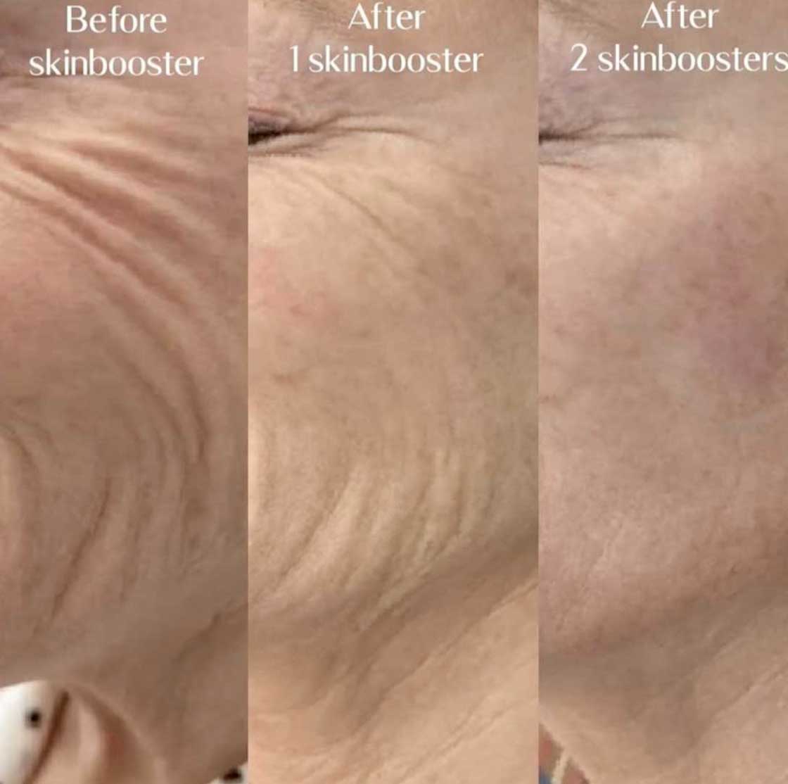 Skin-Booster-Frisco-gallery-2