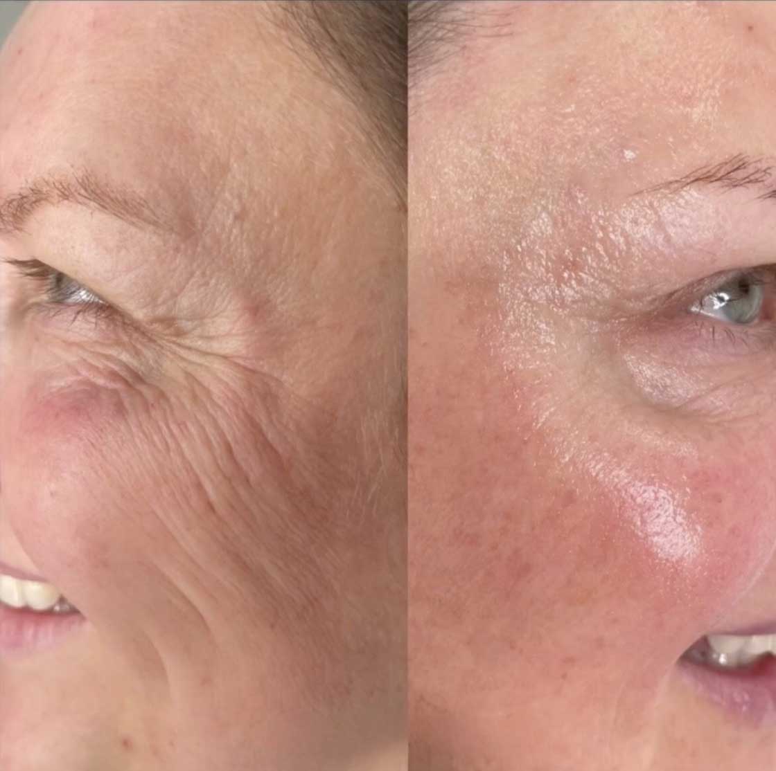 Skin-Booster-Frisco-gallery