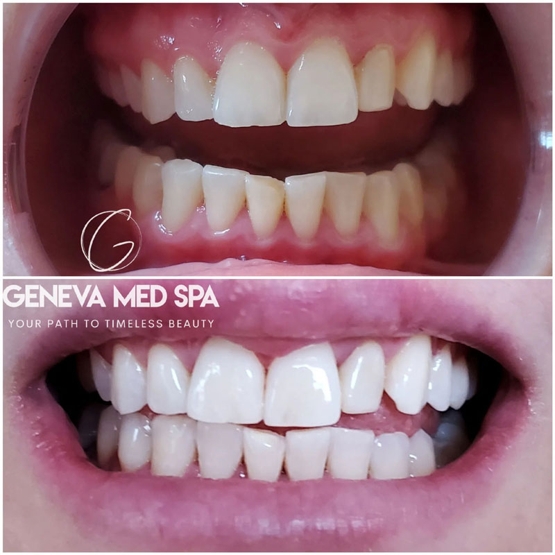 Teeth-Whitening-in-Frisco-TX_5