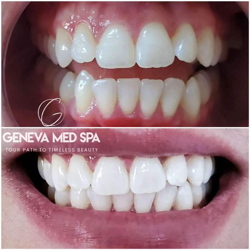 Teeth-Whitening-in-Frisco-TX_6
