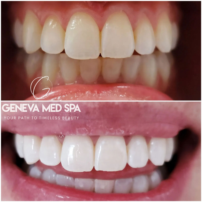 Teeth-Whitening-in-Frisco-TX_7