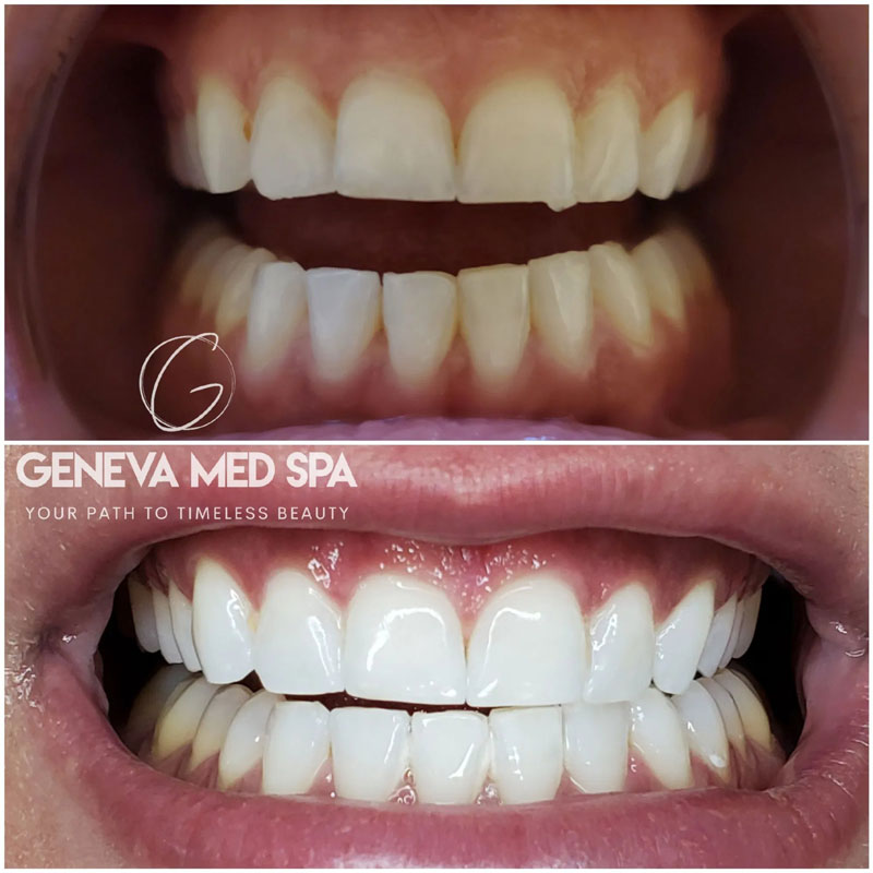 Teeth-Whitening-in-Frisco-TX_8