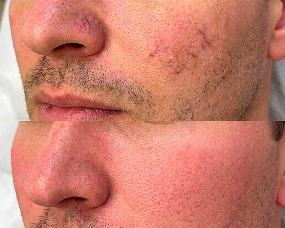 Vascular-Lesion-&-Vein-Treatment-gallery-2