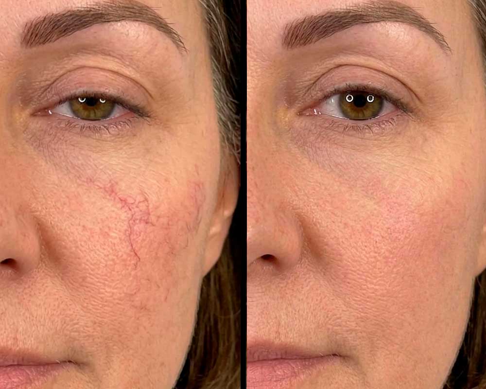 Vascular-Lesion-&-Vein-Treatment-gallery-3