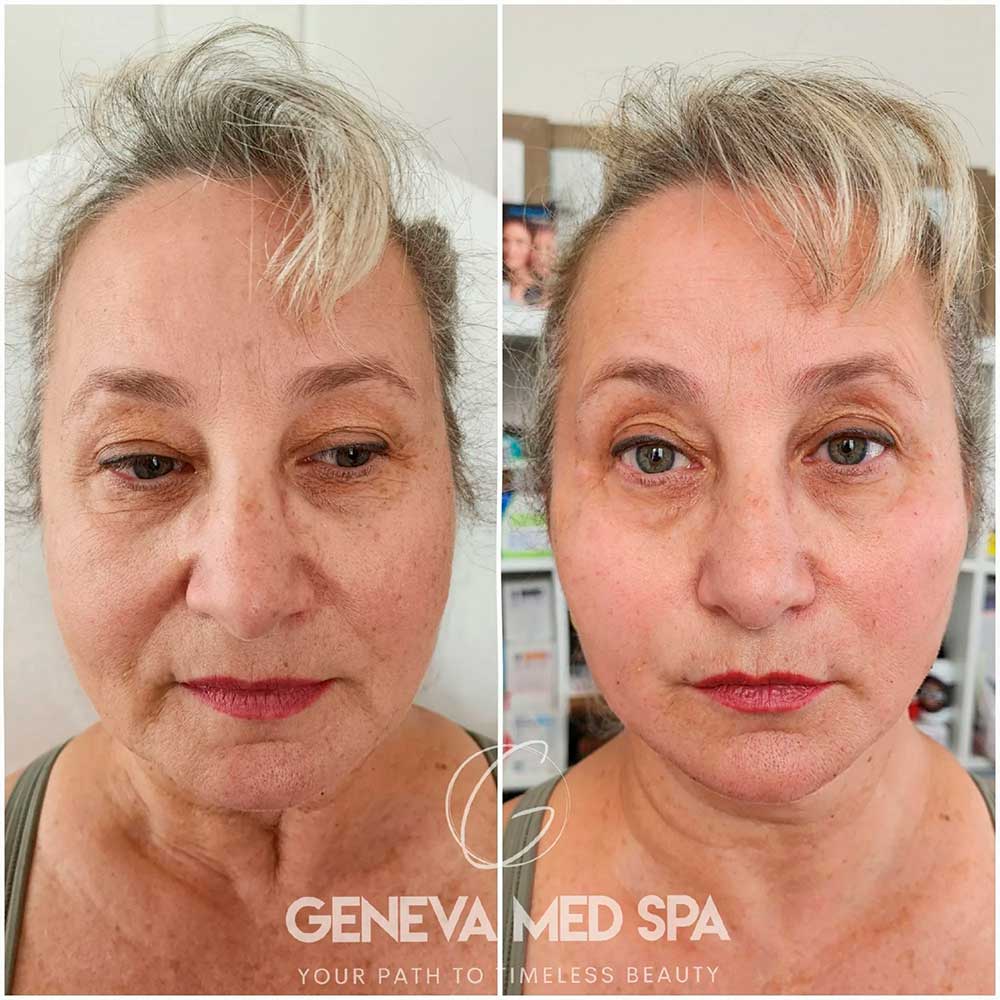 Wrinkle-Treatment-Frisco-gallery-1