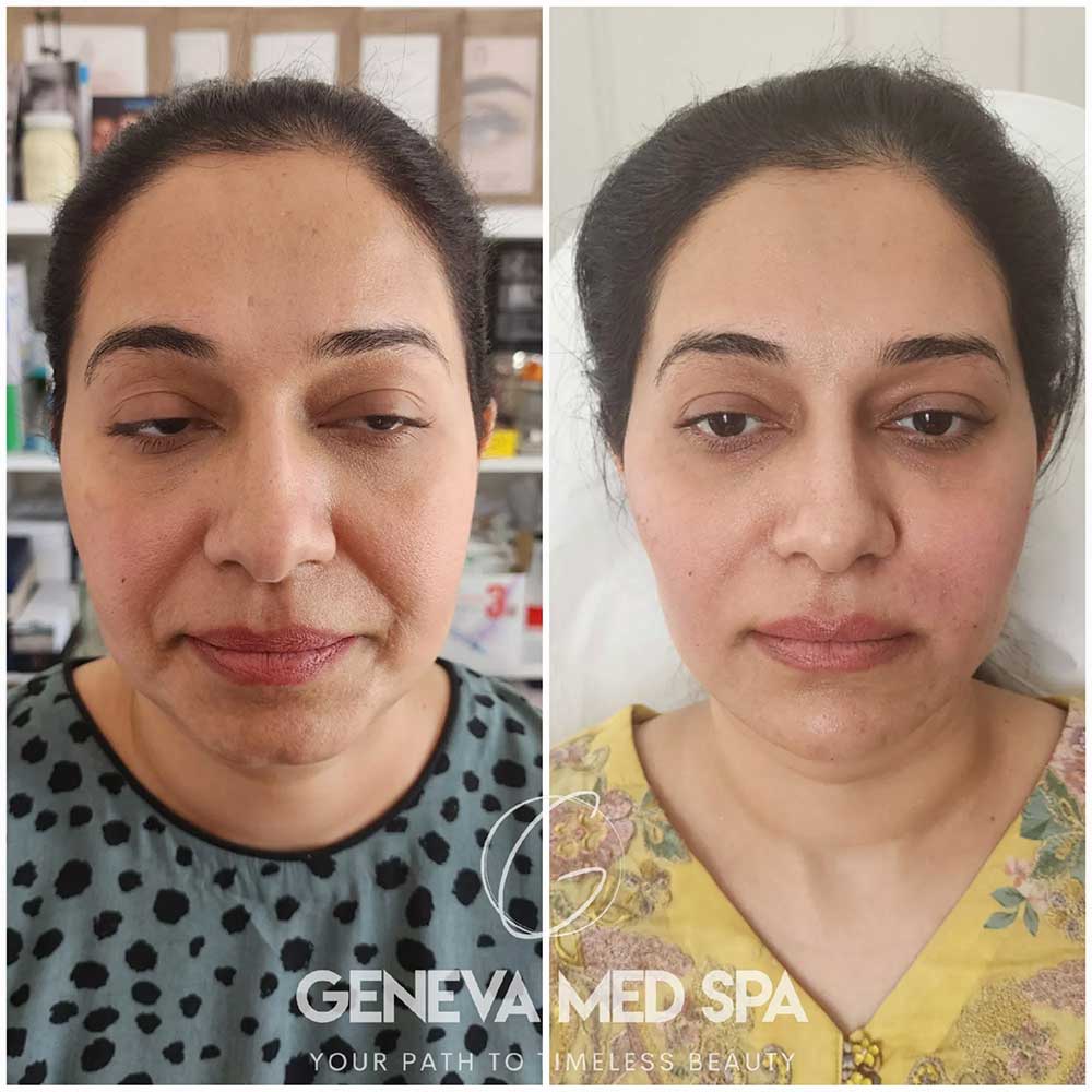 Wrinkle-Treatment-Frisco-gallery-3