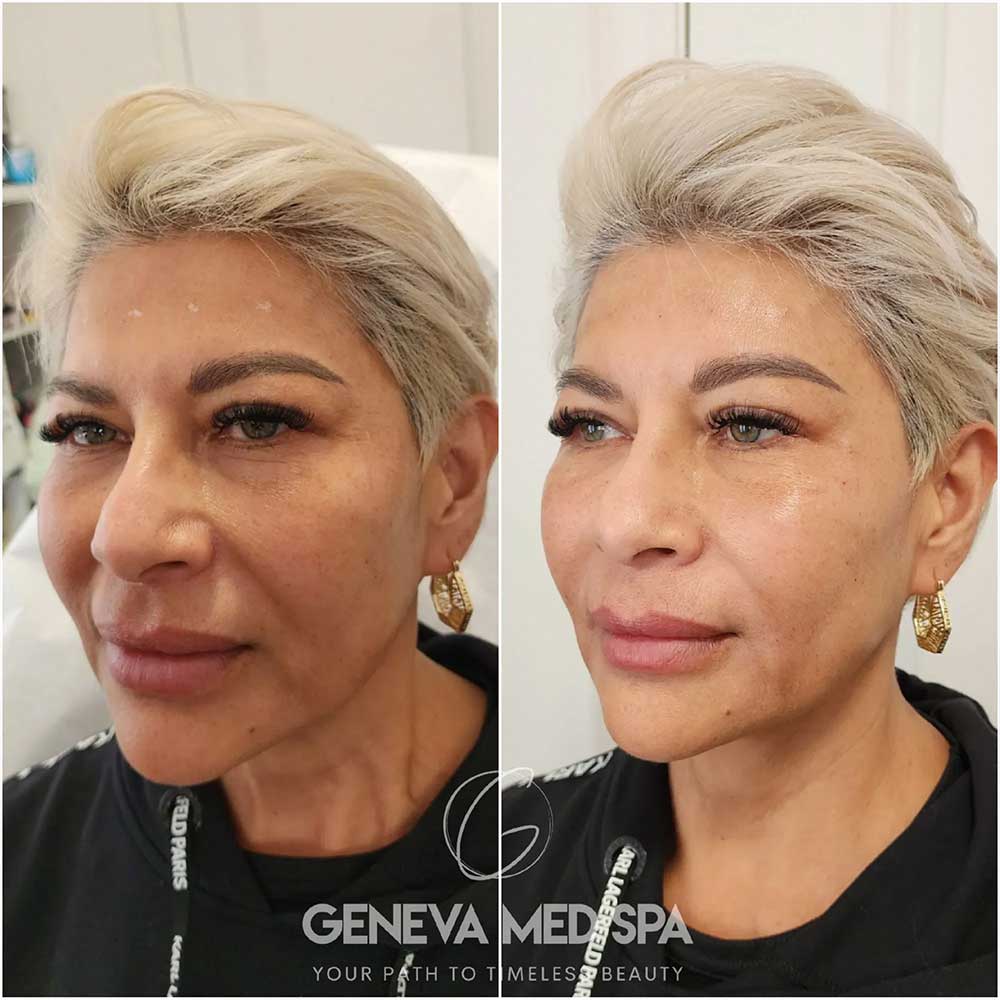 Wrinkle-Treatment-Frisco-gallery-4