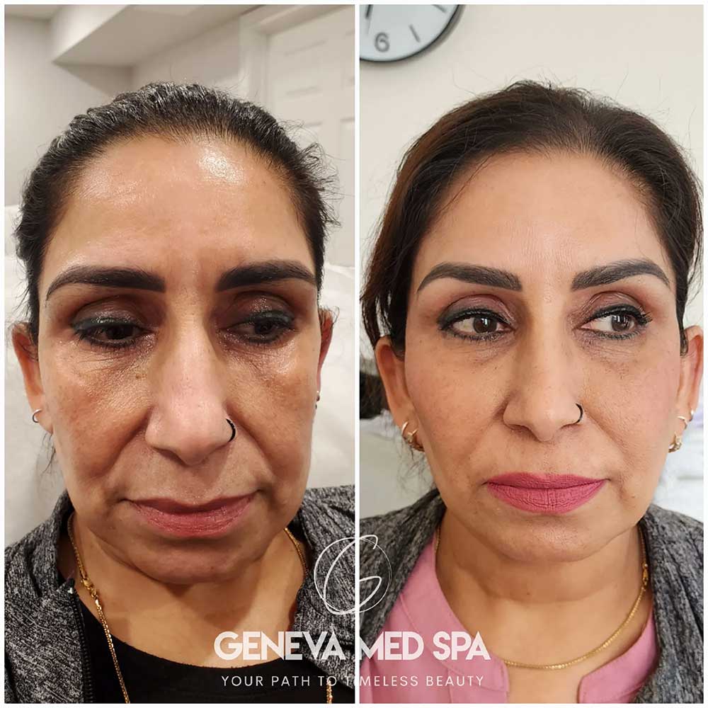 Wrinkle-Treatment-Frisco-gallery