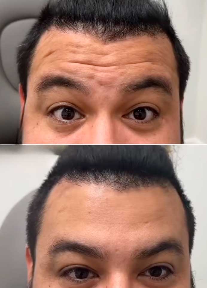 Wrinkle Treatment Frisco TX | Anti-Wrinkle Injections | Geneva Med Spa