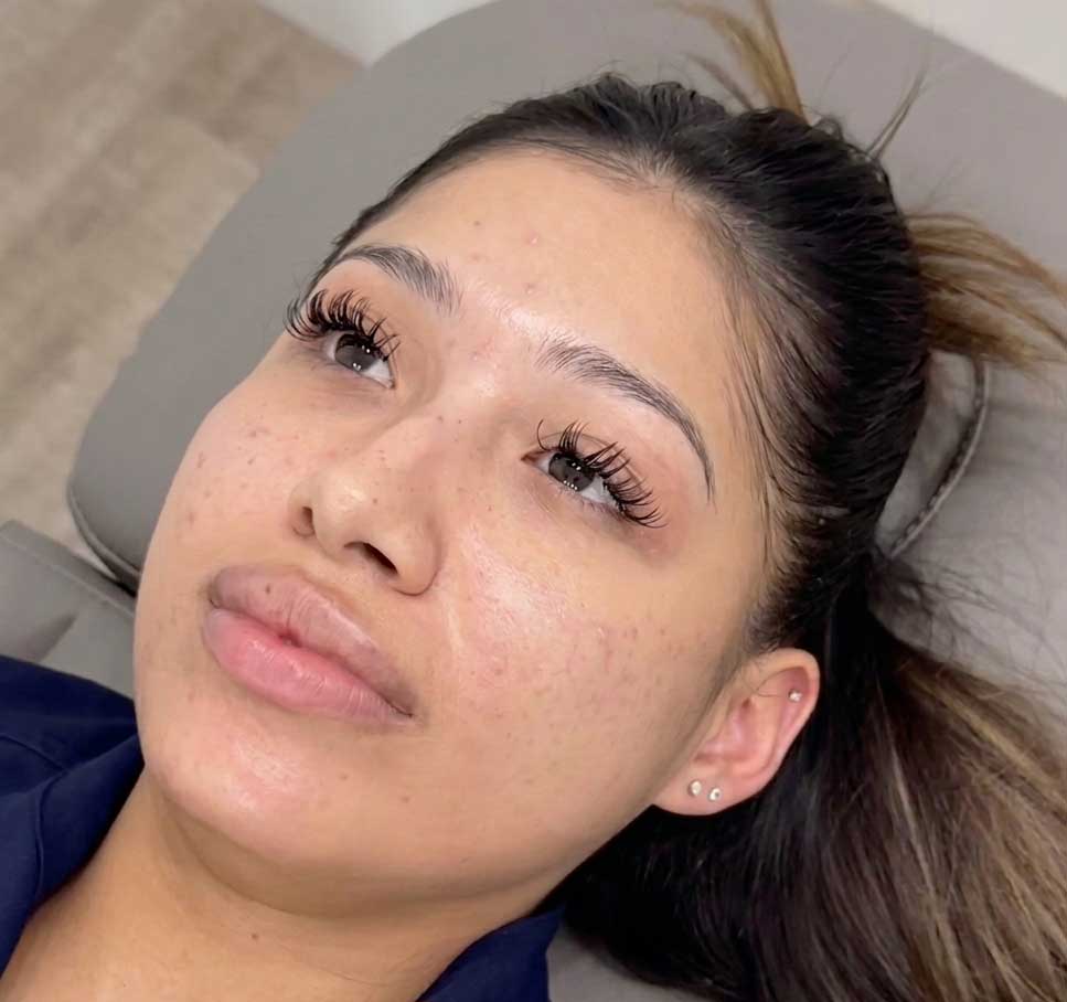 carbon-laser-peel-frisco-gallery