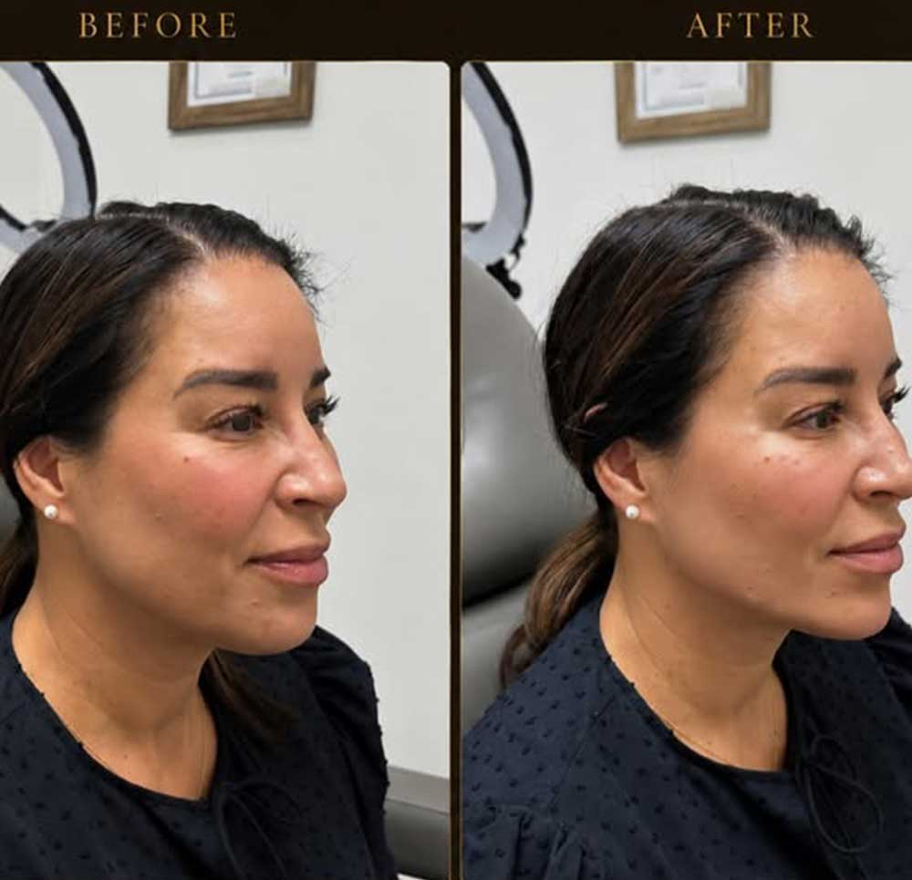 dermal-fillers-frisco-Texas-gallery