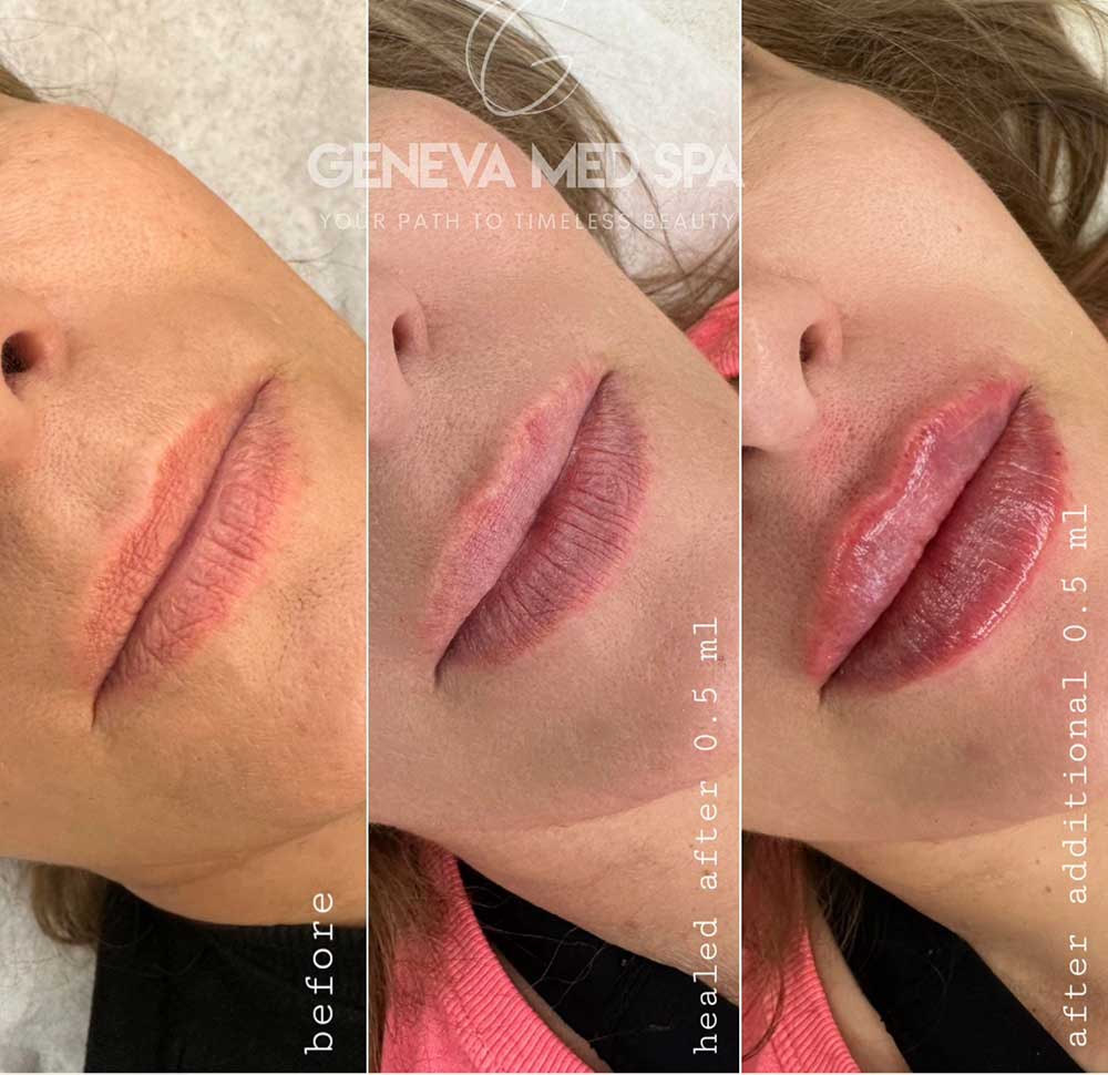 lip-filler-frisco-gallery-3