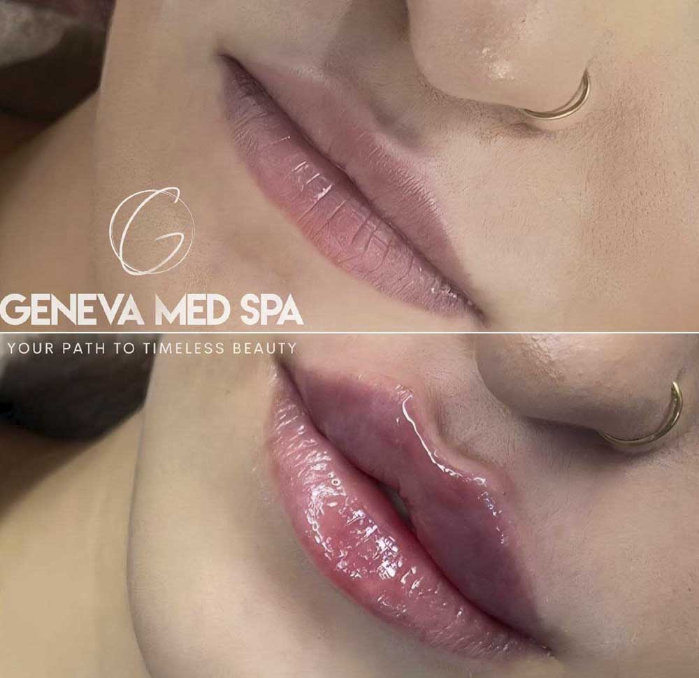 lip-filler-frisco-gallery