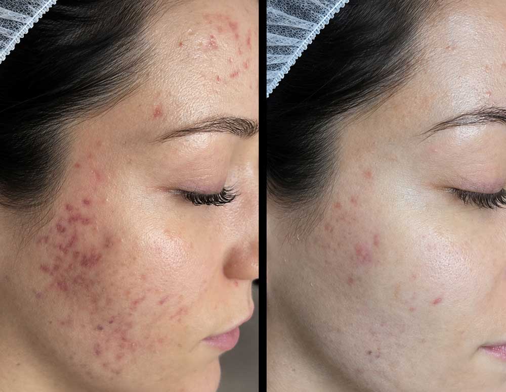microneedling-frisco-gallery-1