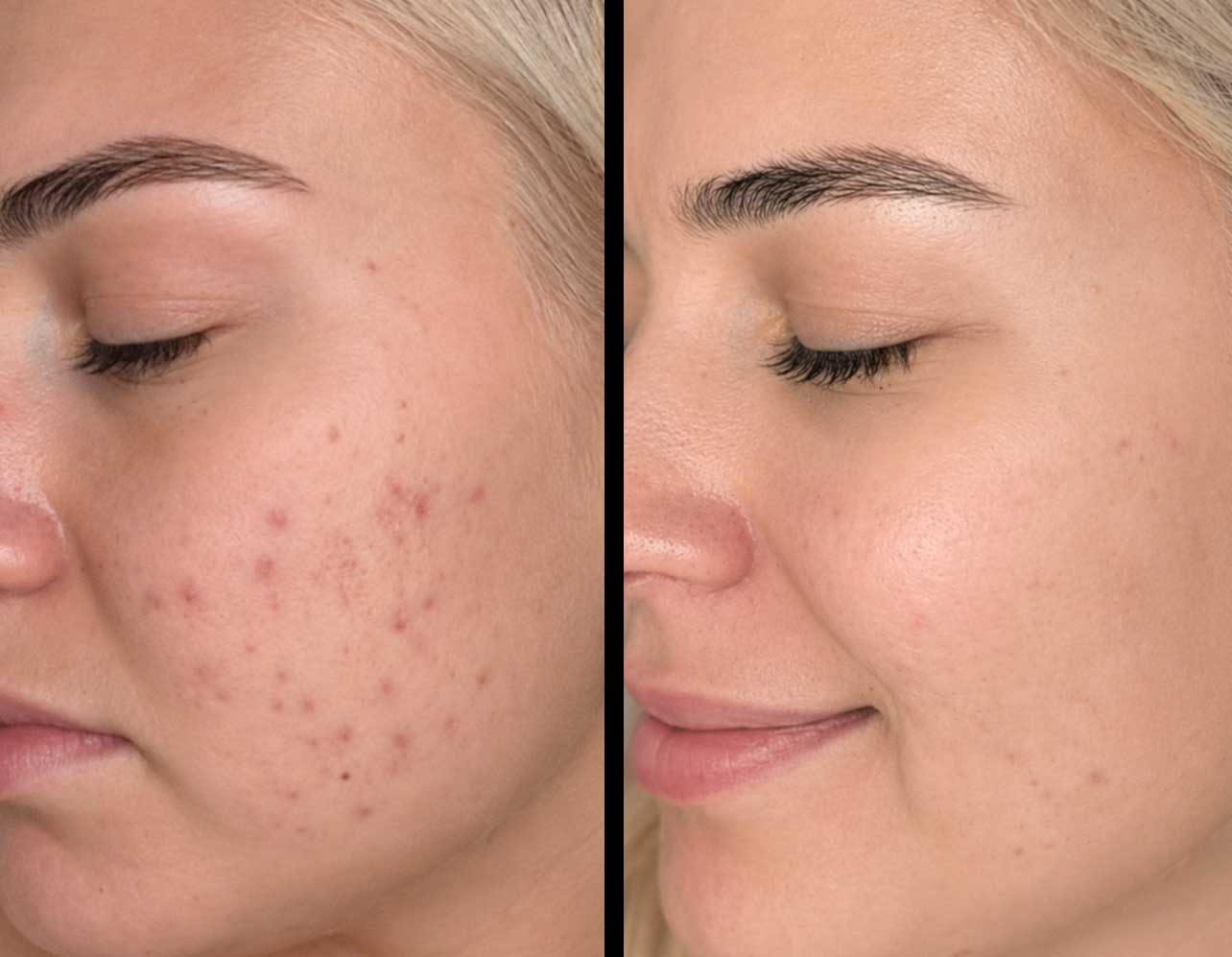 microneedling-frisco-gallery-2