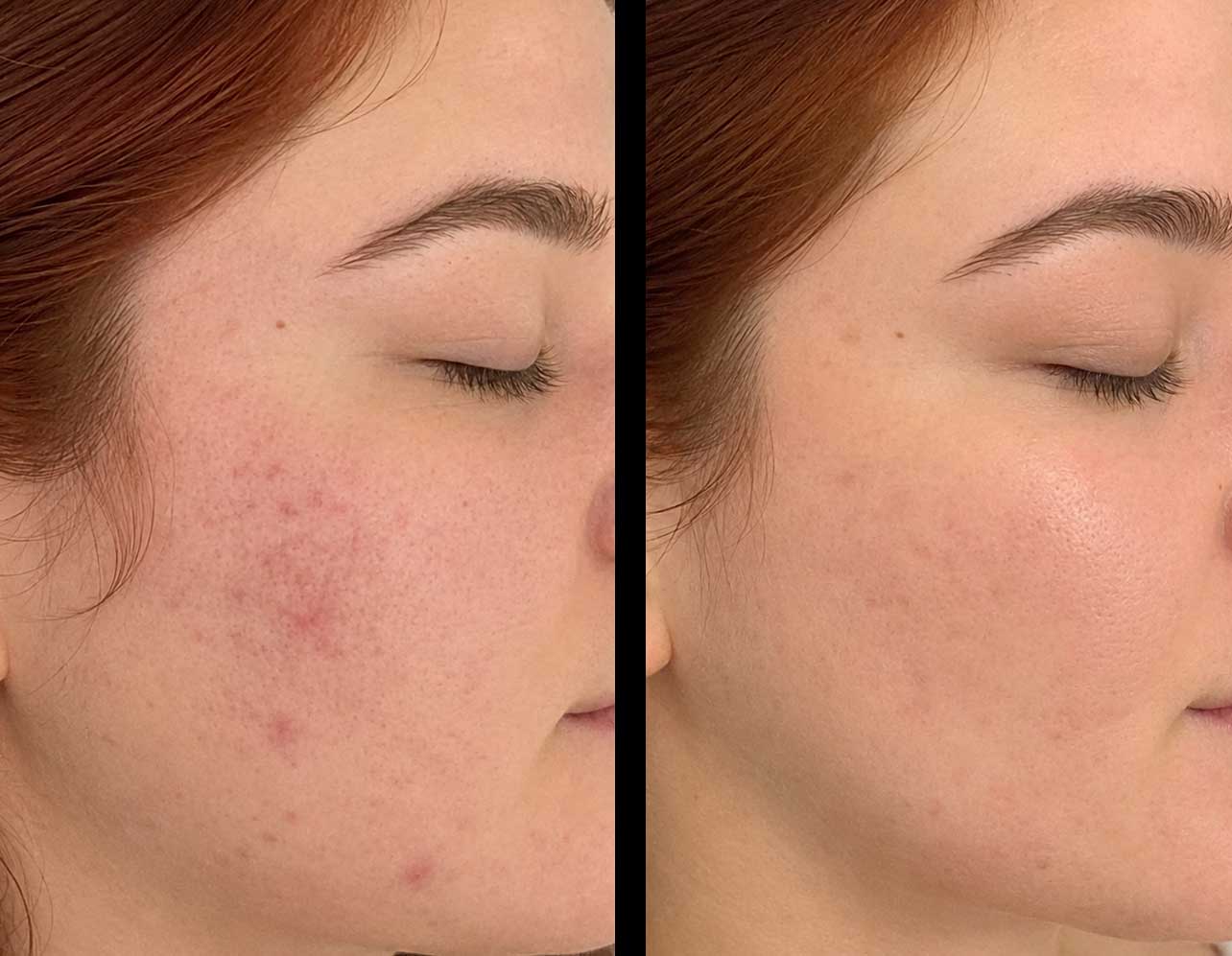 microneedling-frisco-gallery-3