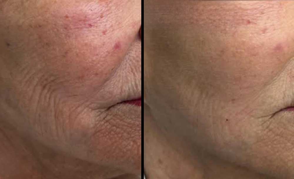 rf-microneedling-frisco-gallery-1