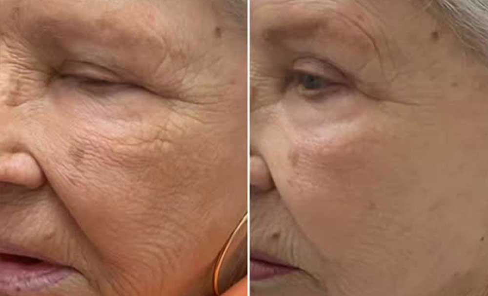 rf-microneedling-frisco-gallery