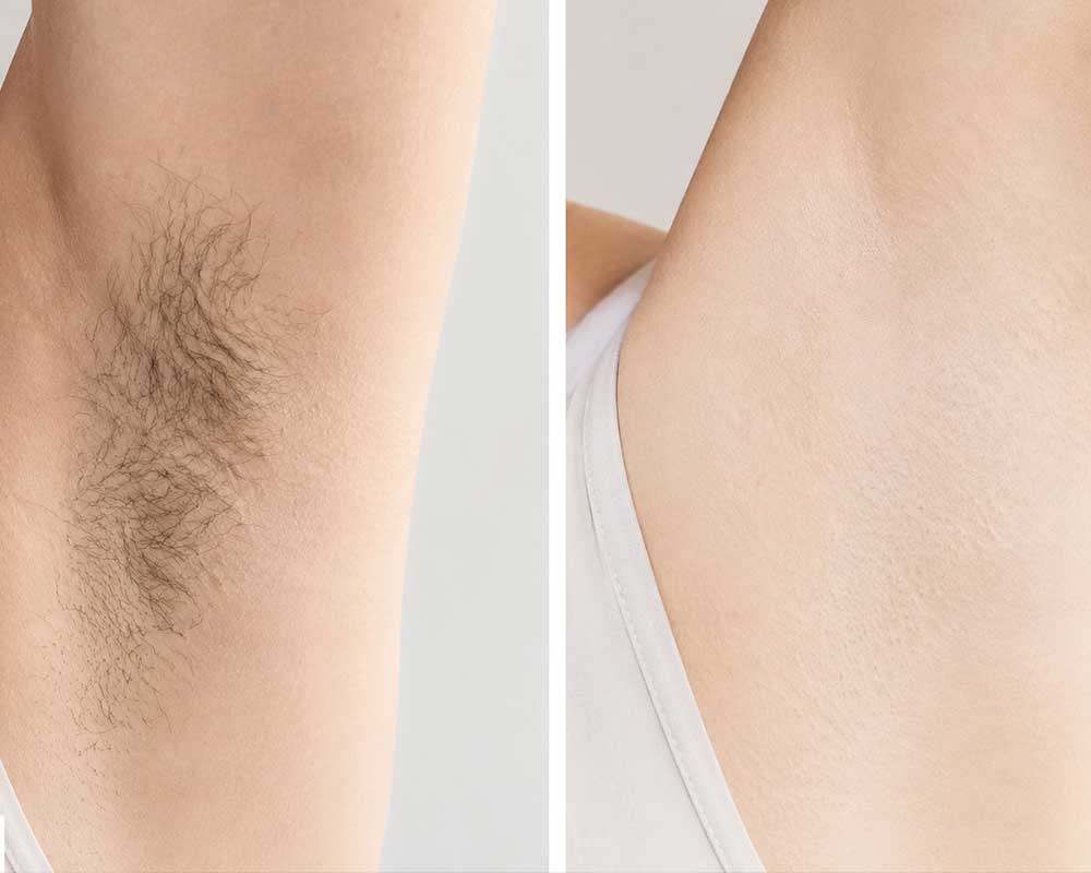 Laser-Hair-Removal-gallery_2