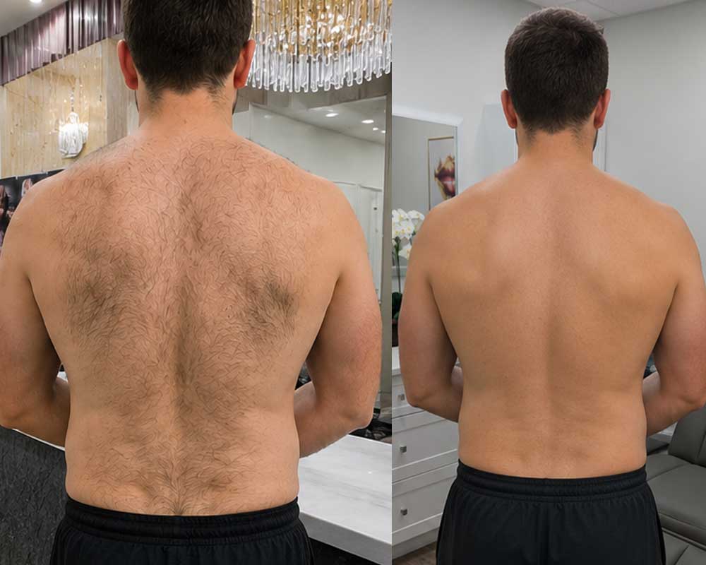 Laser-Hair-Removal-gallery_3