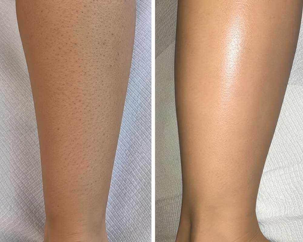 Laser-Hair-Removal-gallery_4