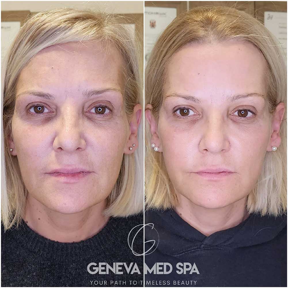 Non-surgical-Face-Lift-gallery-1